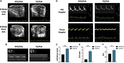 Modifications of Sarcoplasmic Reticulum Function Prevent Progression of Sarcomere-Linked Hypertrophic Cardiomyopathy Despite a Persistent Increase in Myofilament Calcium Response